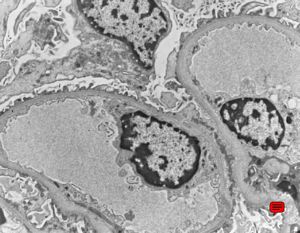 F,2y. | normal kidney F,2y. | normal kidney